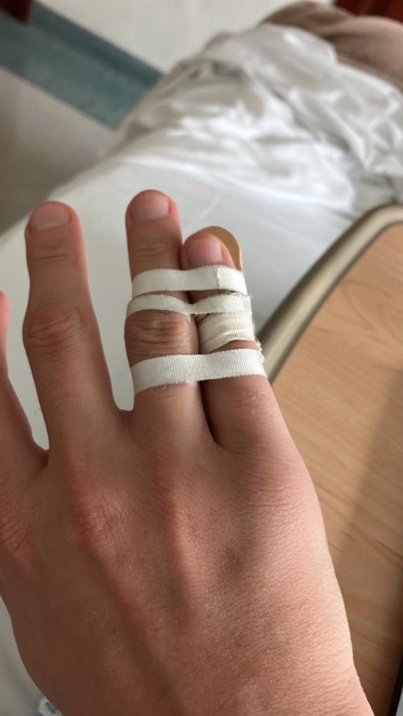 Broken pinkie